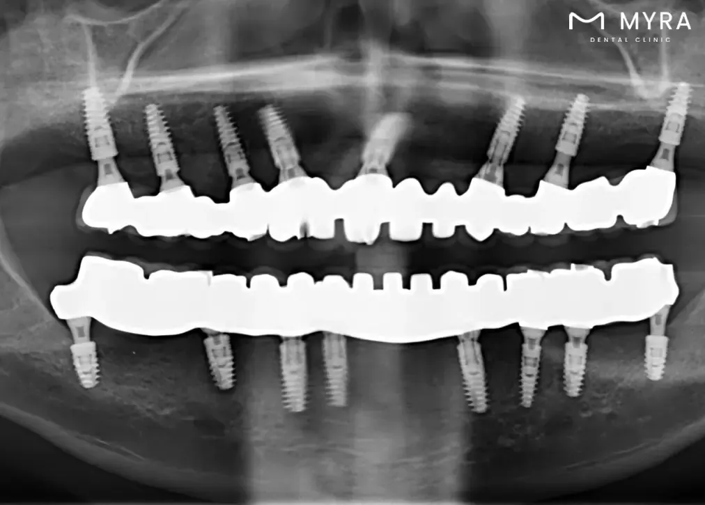 How common is sirona 3d dental tomography in dentistry?