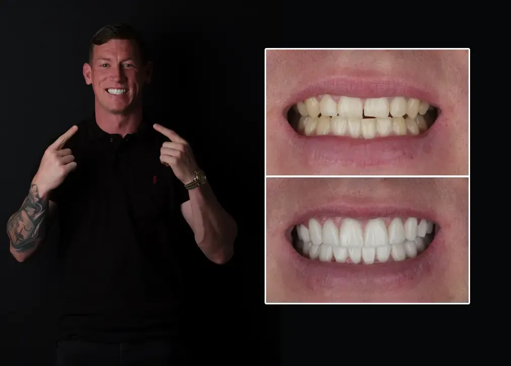 How do i care for dental bridges?