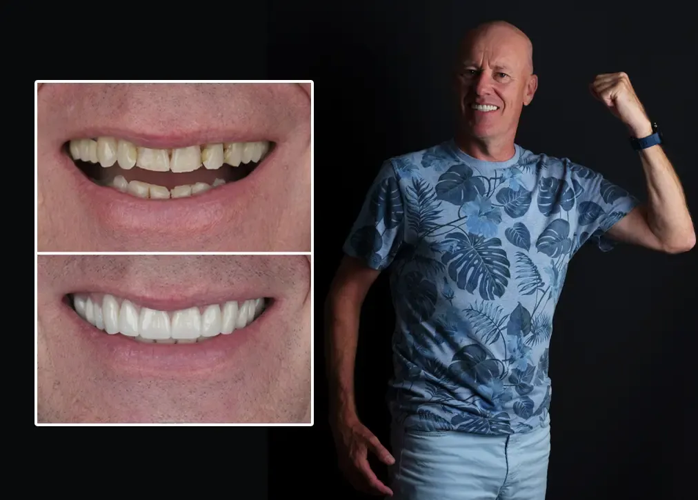 How is a dental bridge performed?