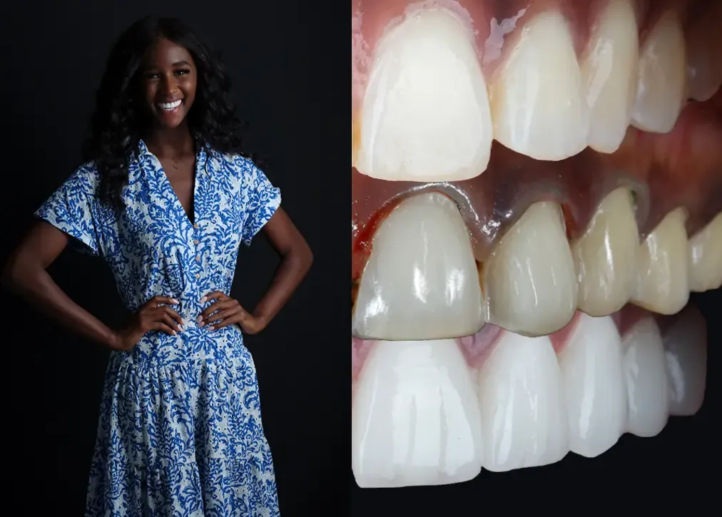 How is hollywood smile in turkey treatment done?