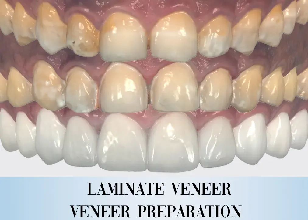 How is laminate veneer treatment done