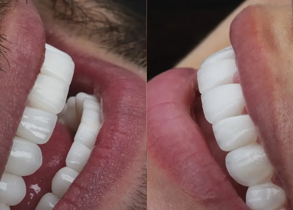 How is the hollywood smile performed?