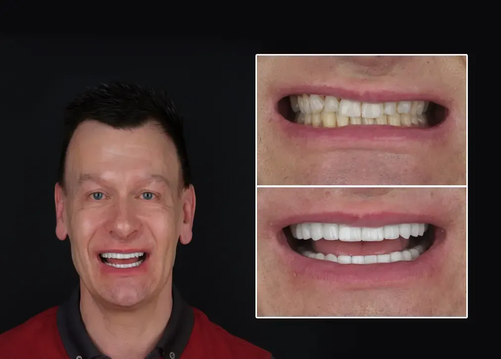 How long does dental bridge in turkey treatment take?