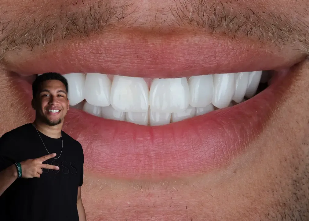 How much do laminate veneers cost