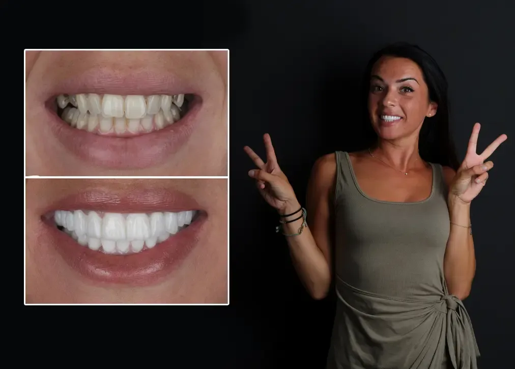 How much does a dental bridge cost in turkey?