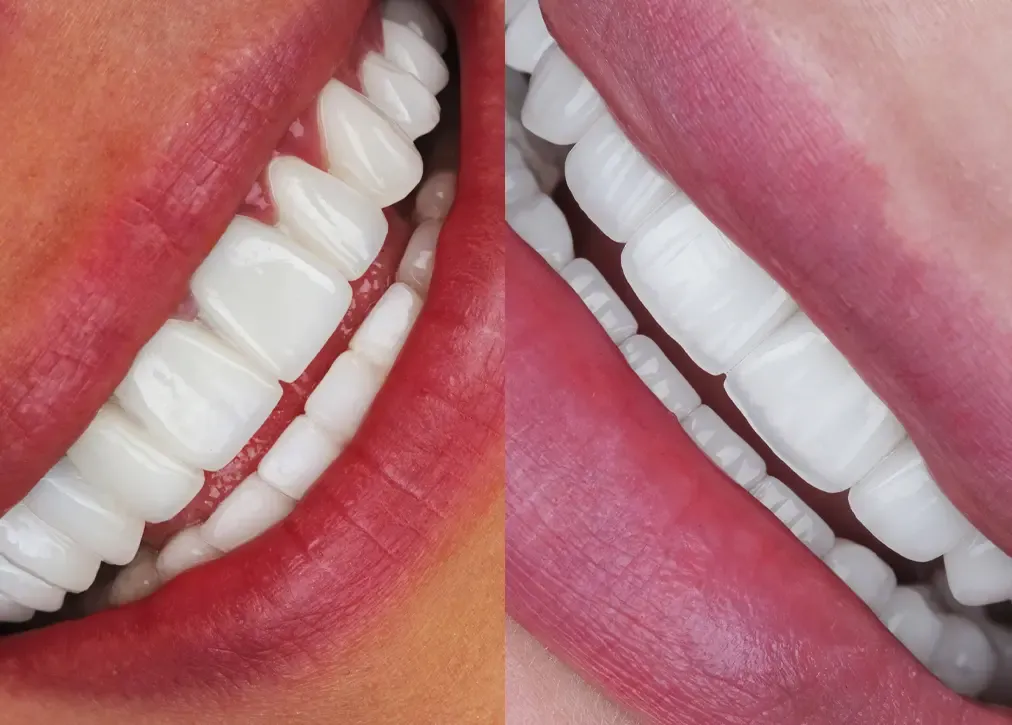 How to maintain a hollywood smile