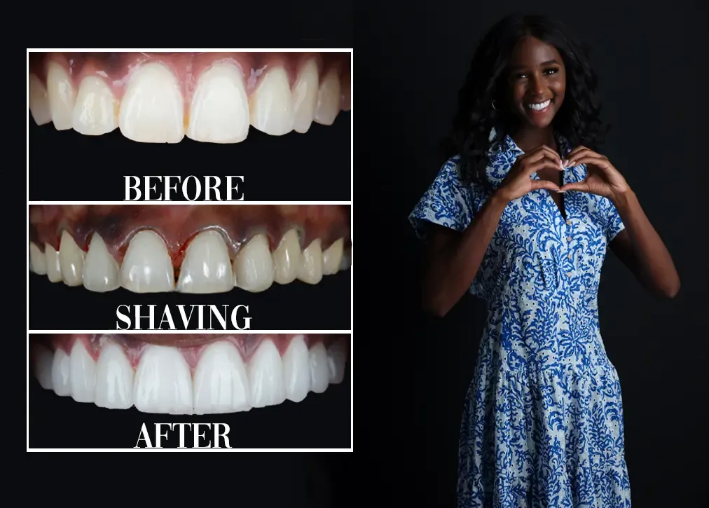 Laminate veneers in turkey: Definition, importance, types, procedure and advantages