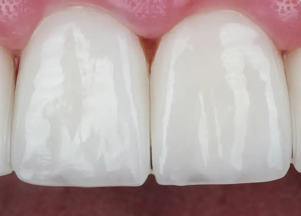 What are hollywood smile materials?