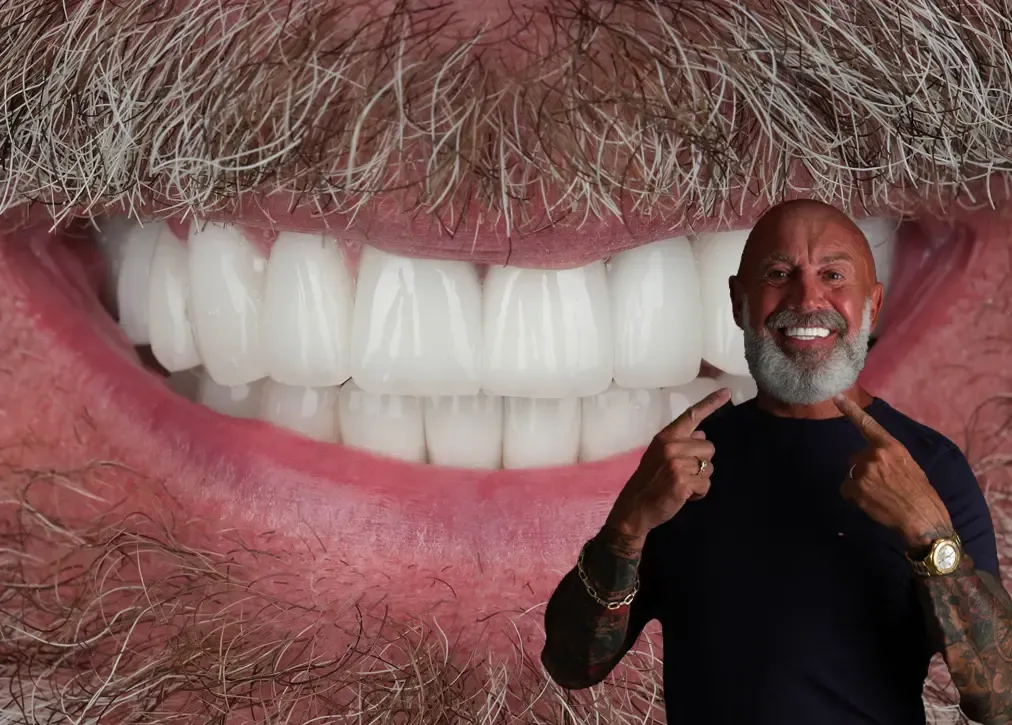 What are laminate veneers in turkey