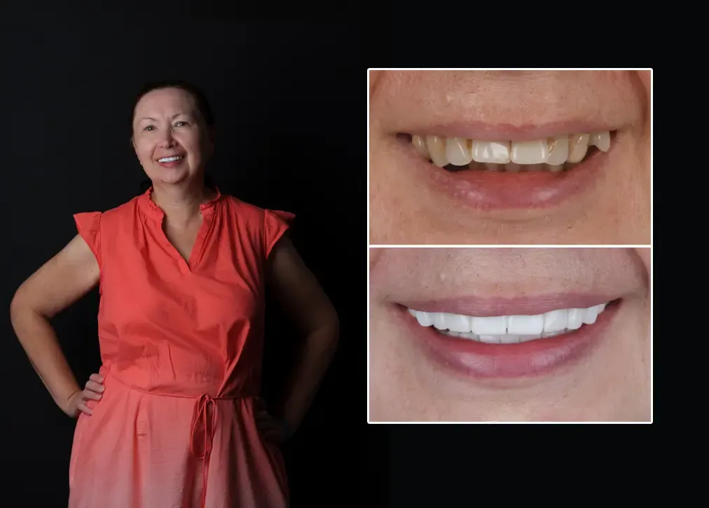 What are the benefits of dental bridges in turkey?