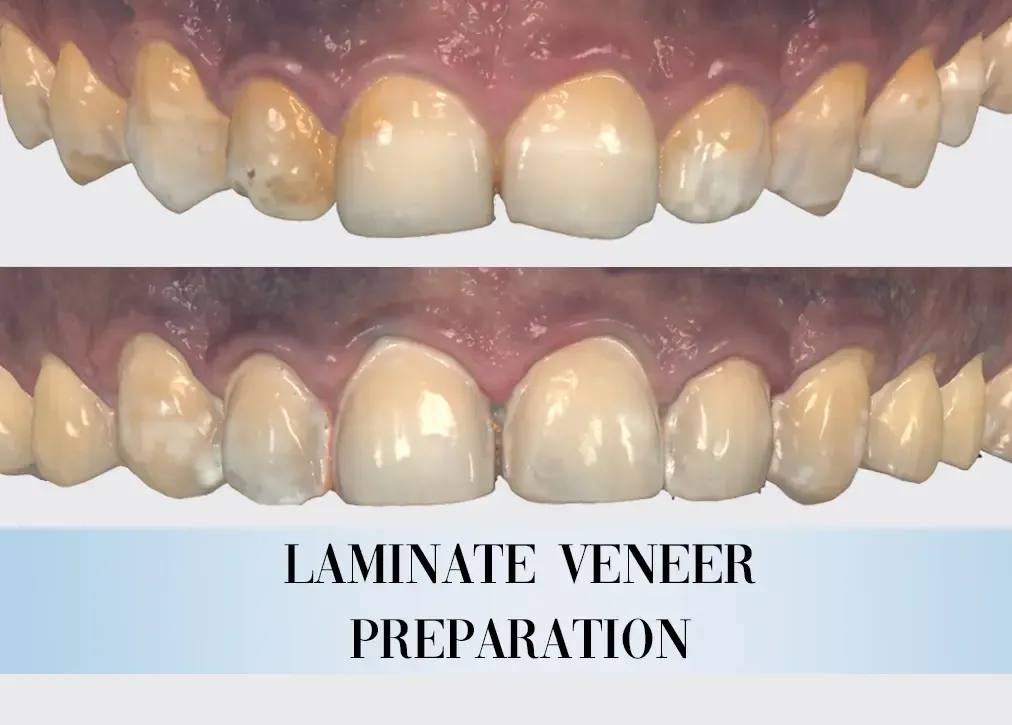 What are the benefits of hollywood smile in turkey?