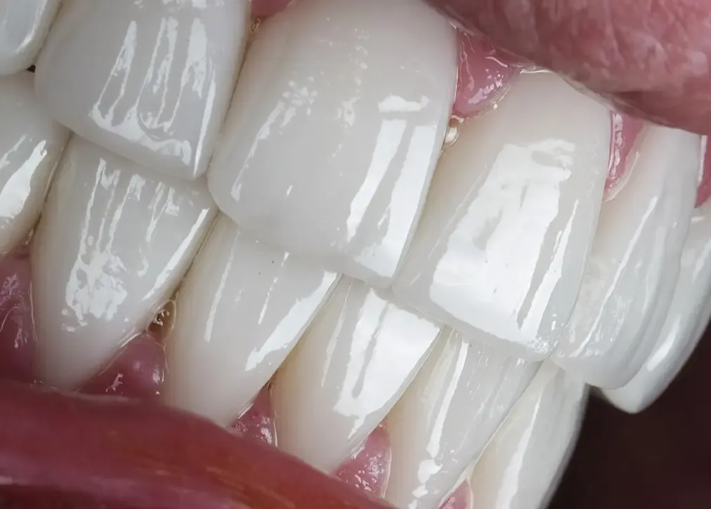 What are the benefits of hollywood smile in turkey?