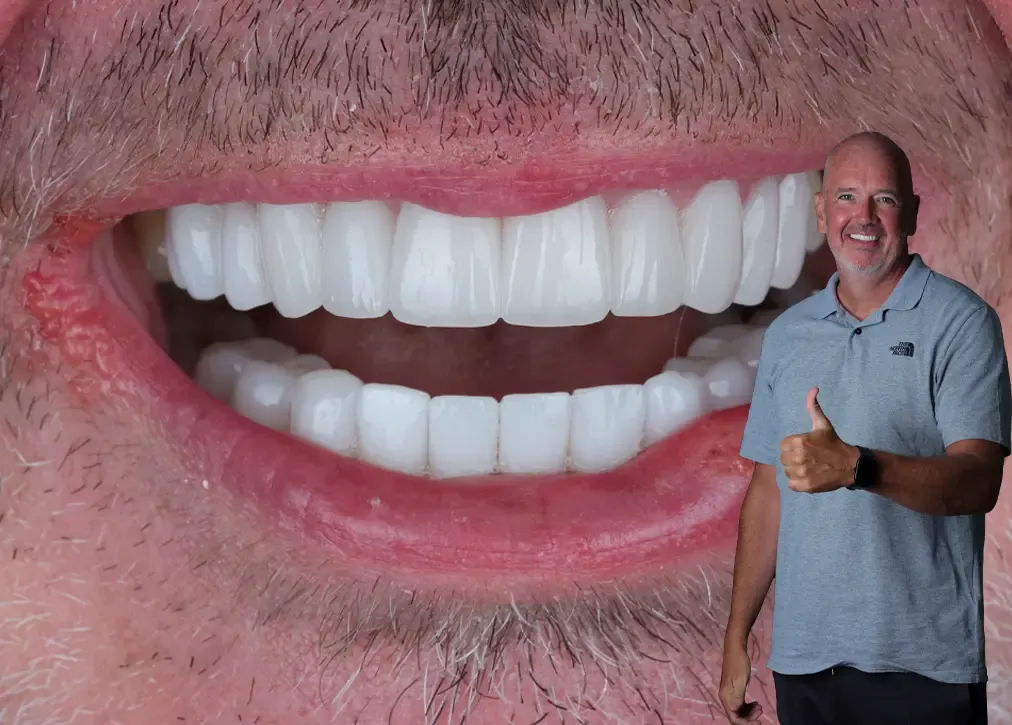 What are the downsides of laminate veneers in turkey