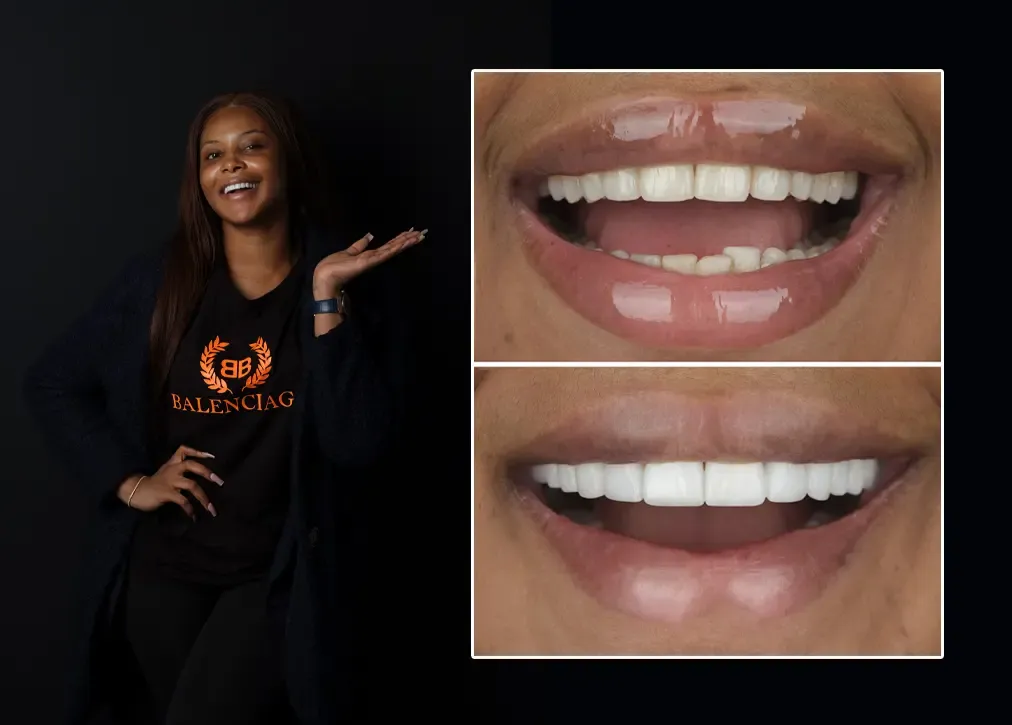 What are the situations in which a dental bridge in turkey is preferred?