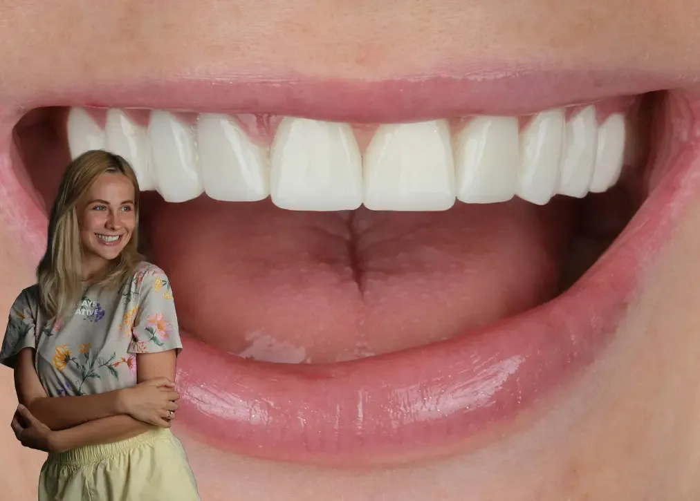 What are the situations in which laminate veneers in turkey are preferred