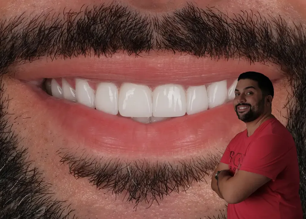 What is the importance of laminate veneers in turkey