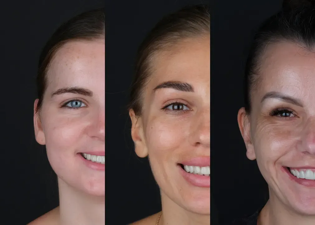 What is the importance of the hollywood smile in turkey?