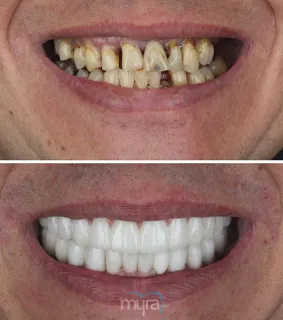 All-on-dental-implants-turkey-missing-teeth-zirconium-BL3