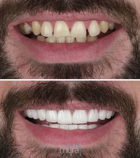 All-on-dental-implants-turkey-missing-teeth-zirconium