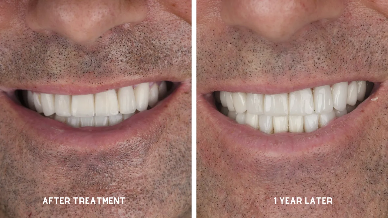 Question about the staining potential of dental veneers