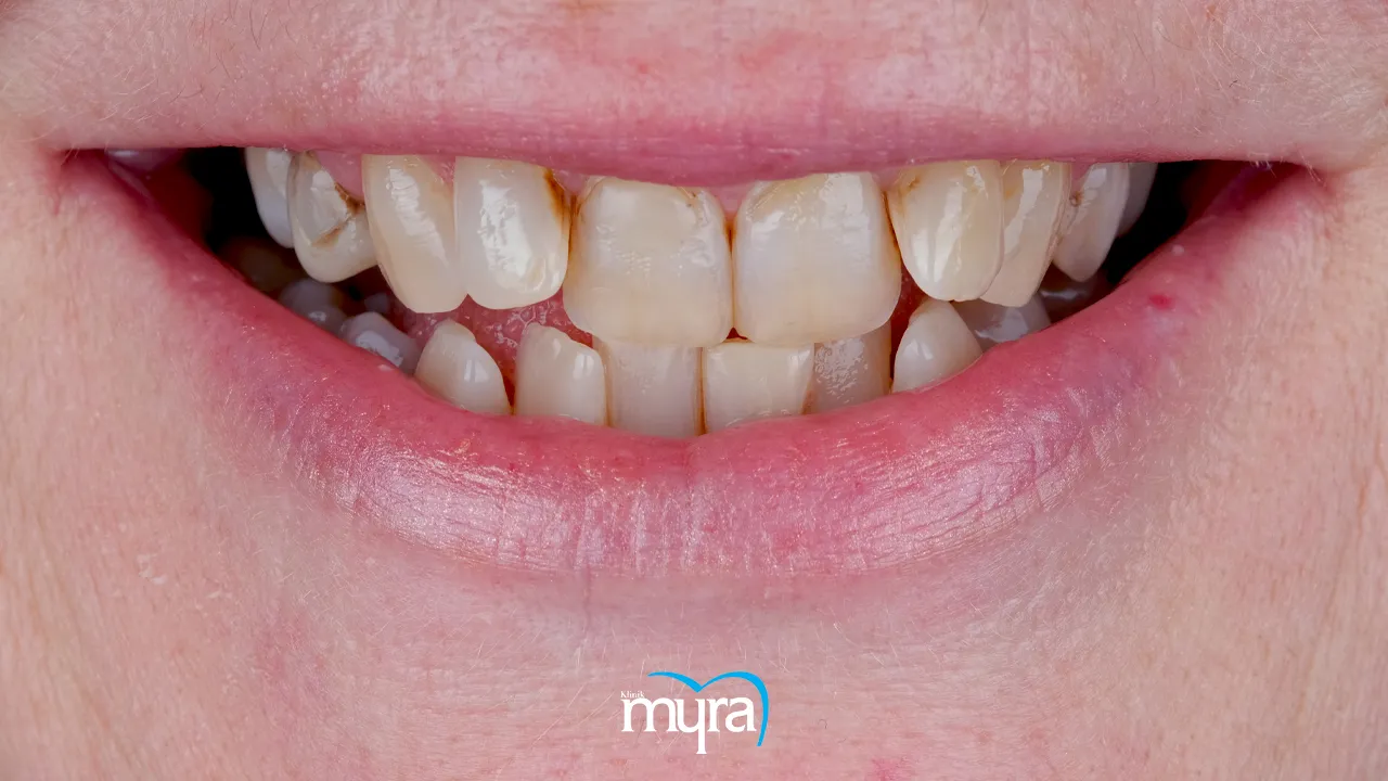 Typical number of veneers required for dental restoration