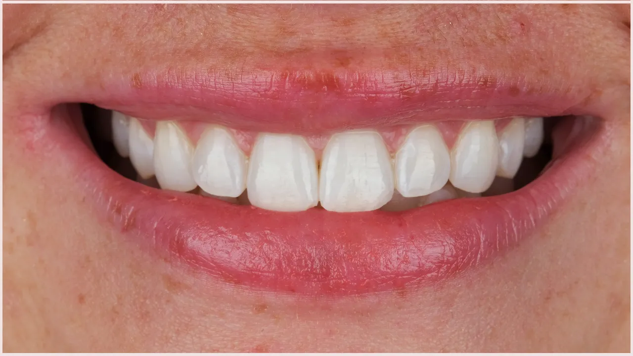 Risks of Teeth Whitening
