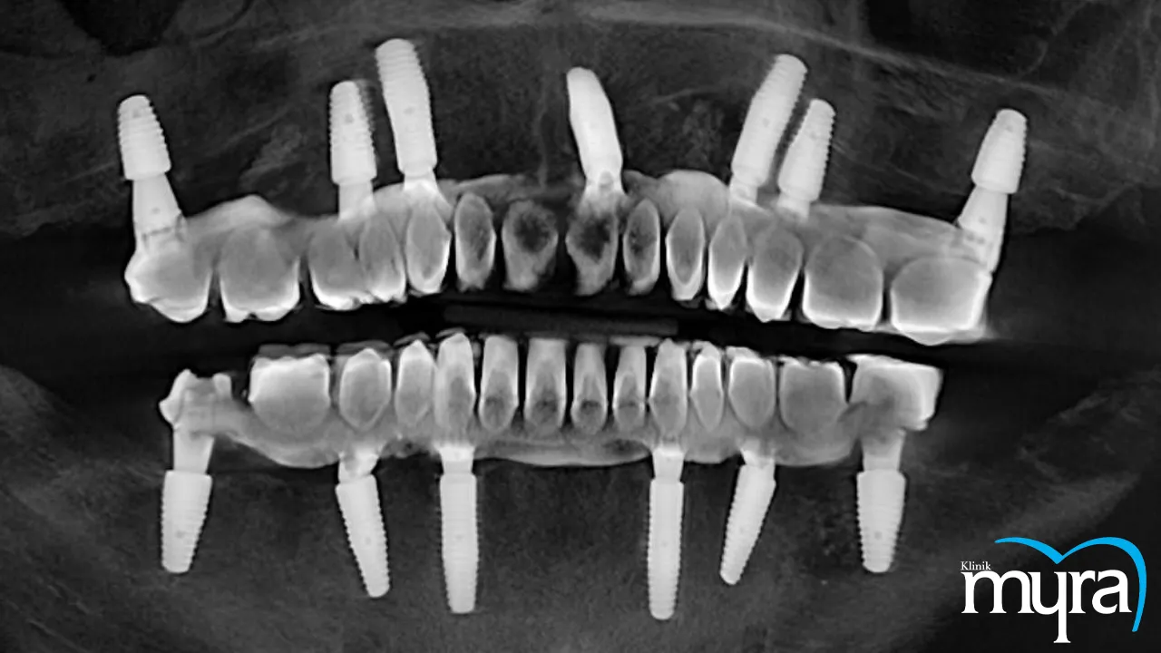 Dental Implant Techniques