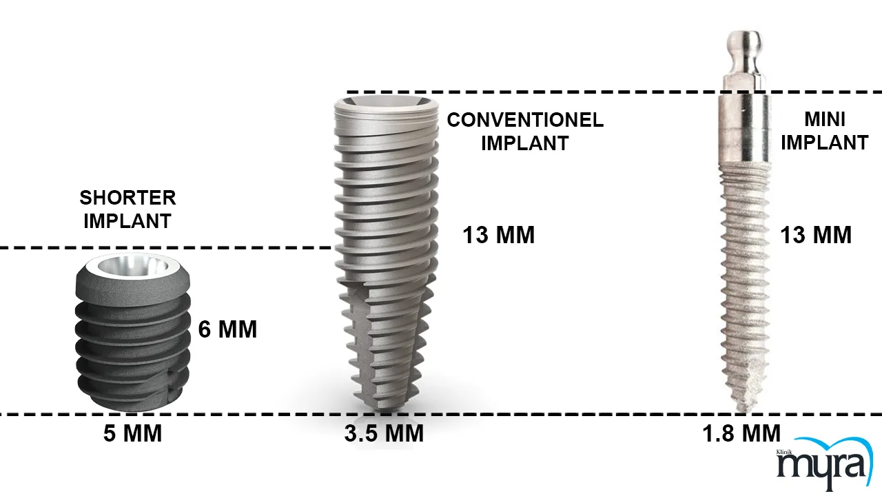 Mini Dental Implants Definition