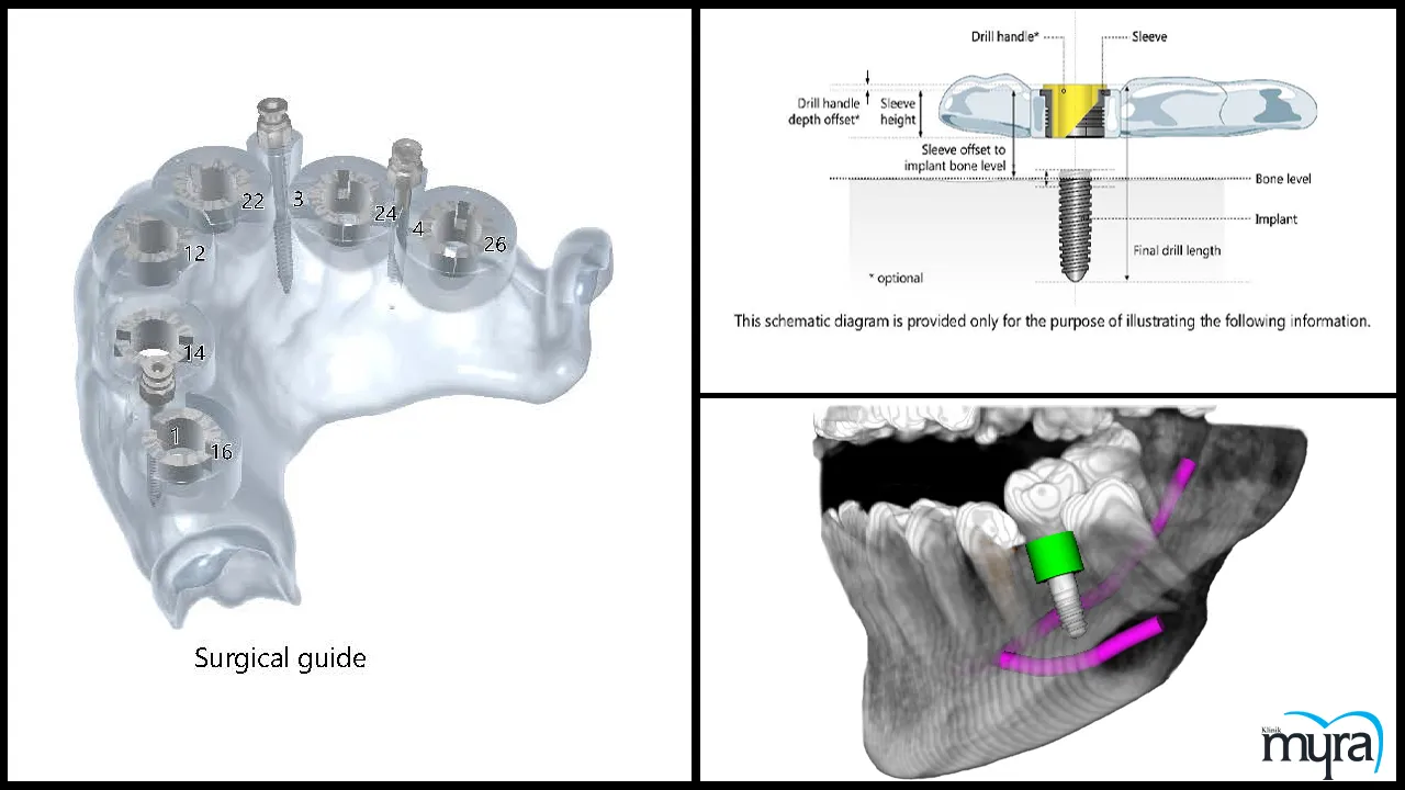 Advance Dental Implant Procedures