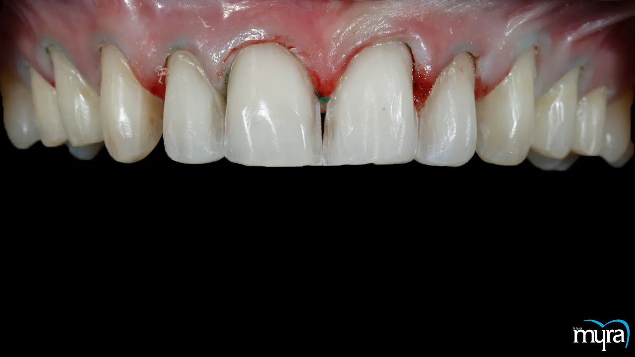 Benefits of Dental Veneers