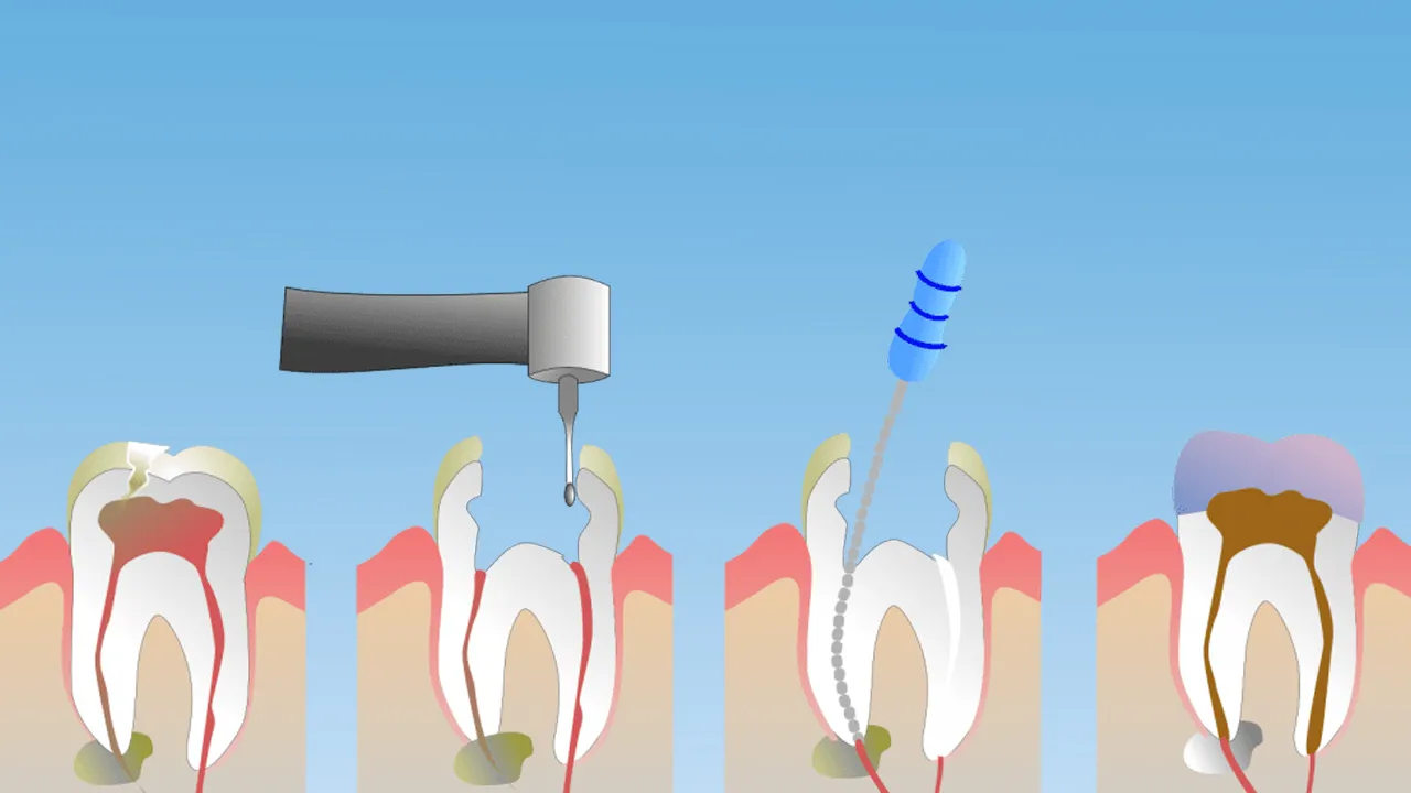 Dental Root Canal Treatments