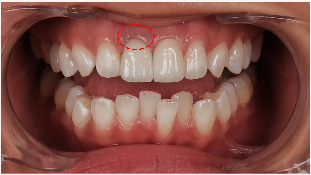 Dental Veneers Risks