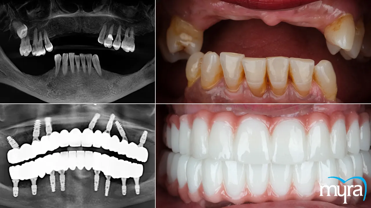 Immediate load dental implant Definition