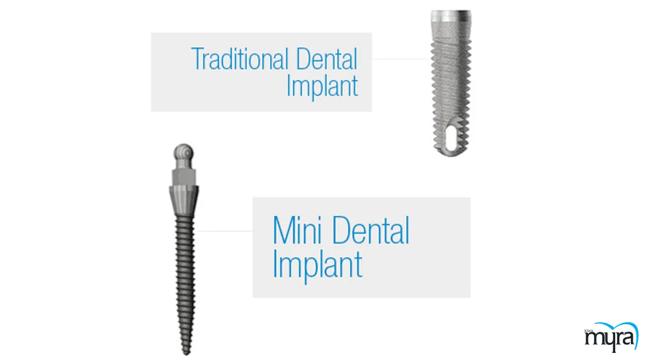 Finding the most affordable tooth implant options