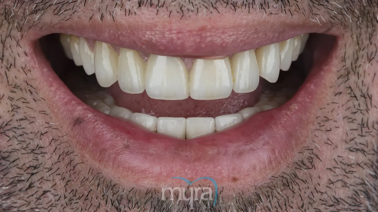 Question about the staining potential of dental veneers
