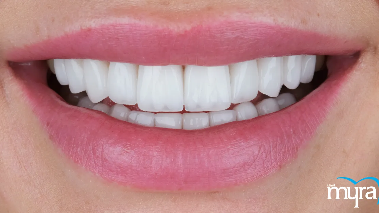 Side Effects of Dental Veneer