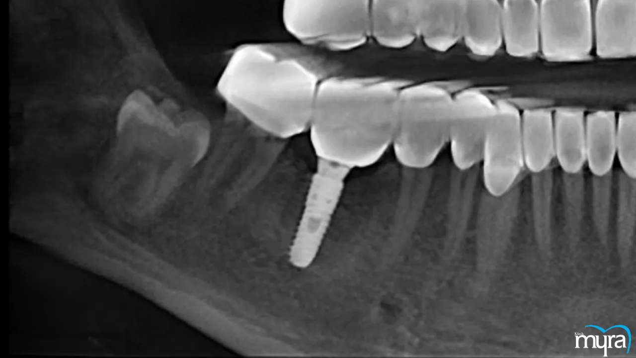 Finding the most affordable tooth implant options