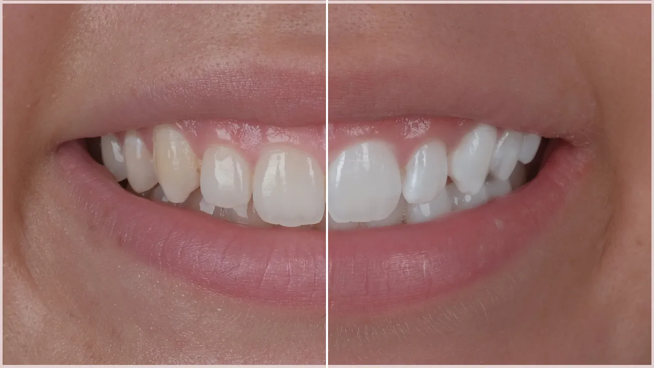 Teeth Whitening vs Laminates