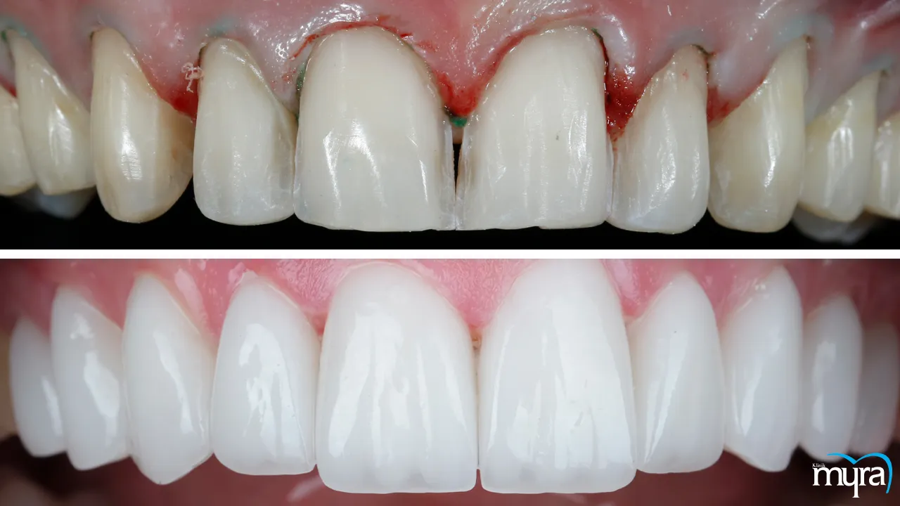 Dental crowns vs dental veneers comparison