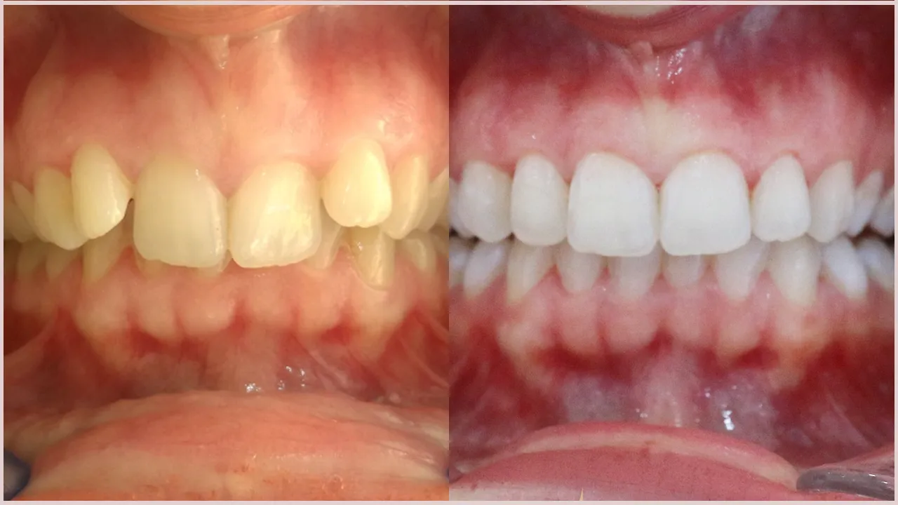 Risks of Teeth Whitening