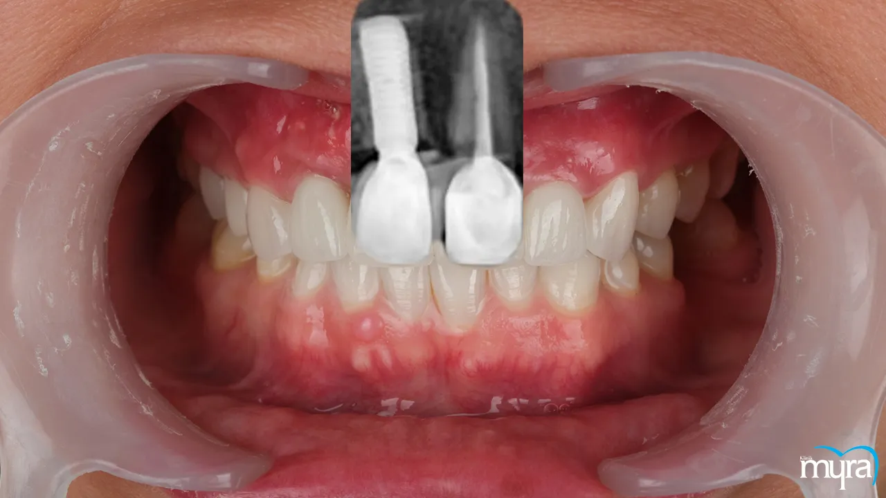 Dental Root Canal
