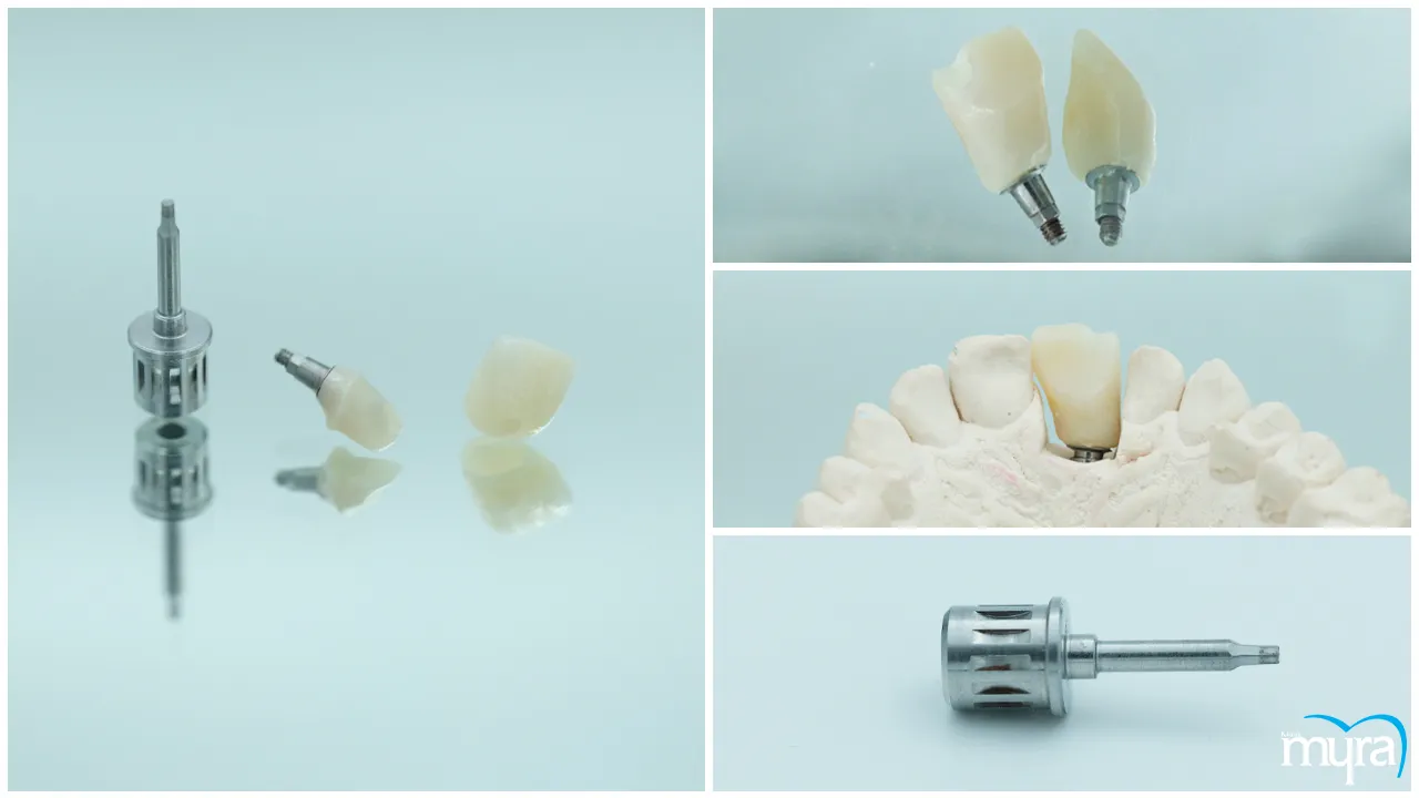 Single Tooth Implant Definition