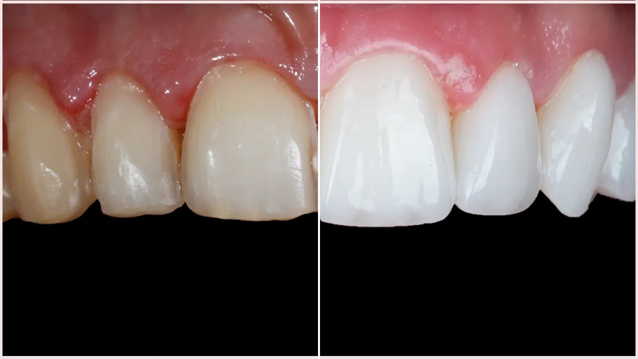 Teeth Whitening vs Laminates