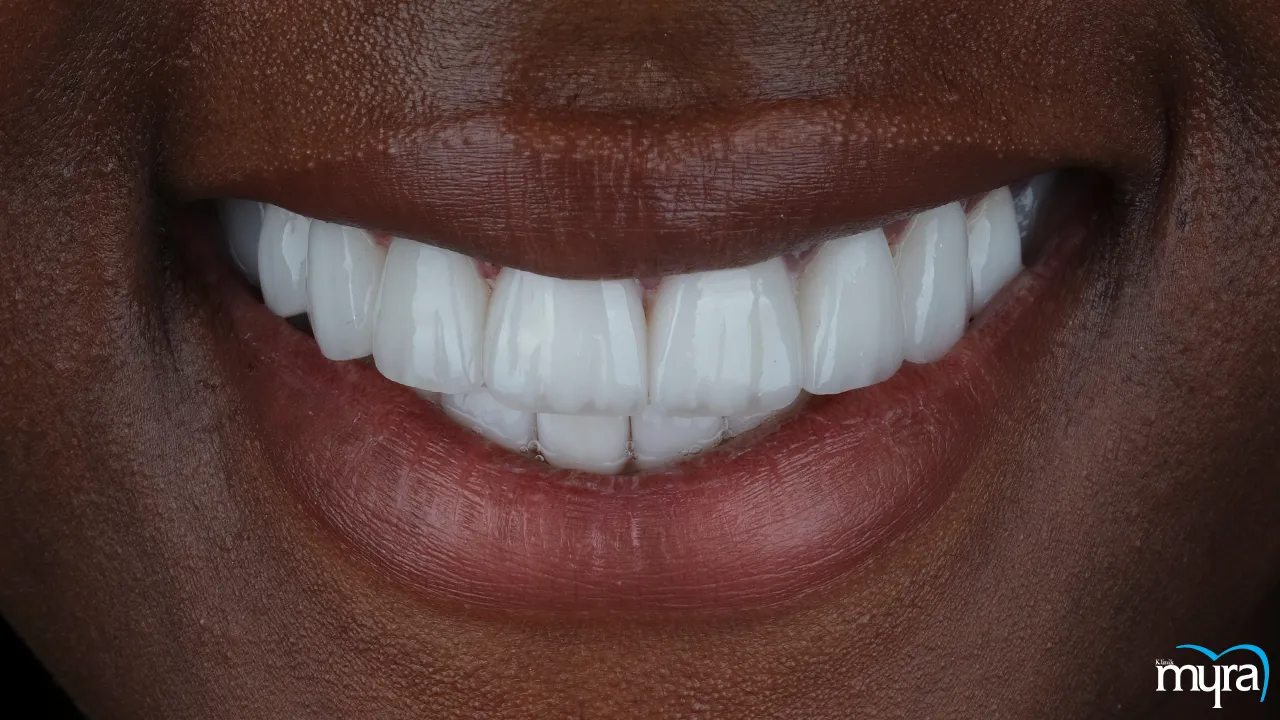 Benefits of Dental Veneers