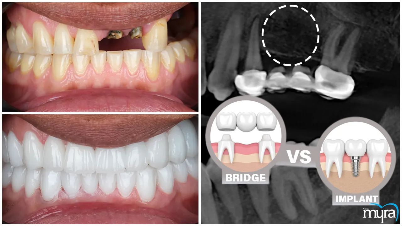 Single Tooth Implant Definition