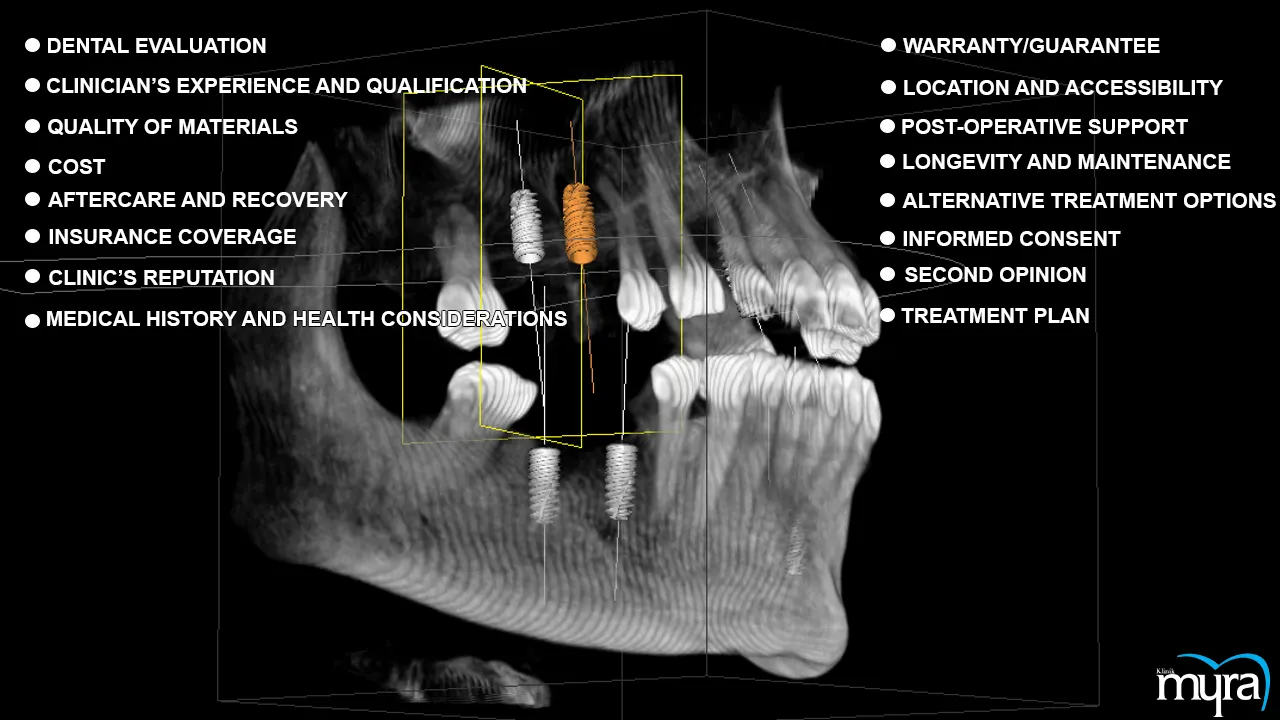 Key information about new teeth restoration with implants in Turkey