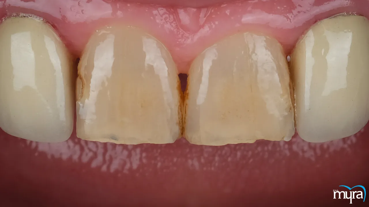 Dental Root Canal