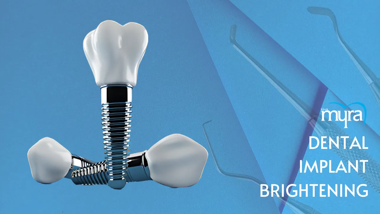 Investigating the possibility of whitening dental implants