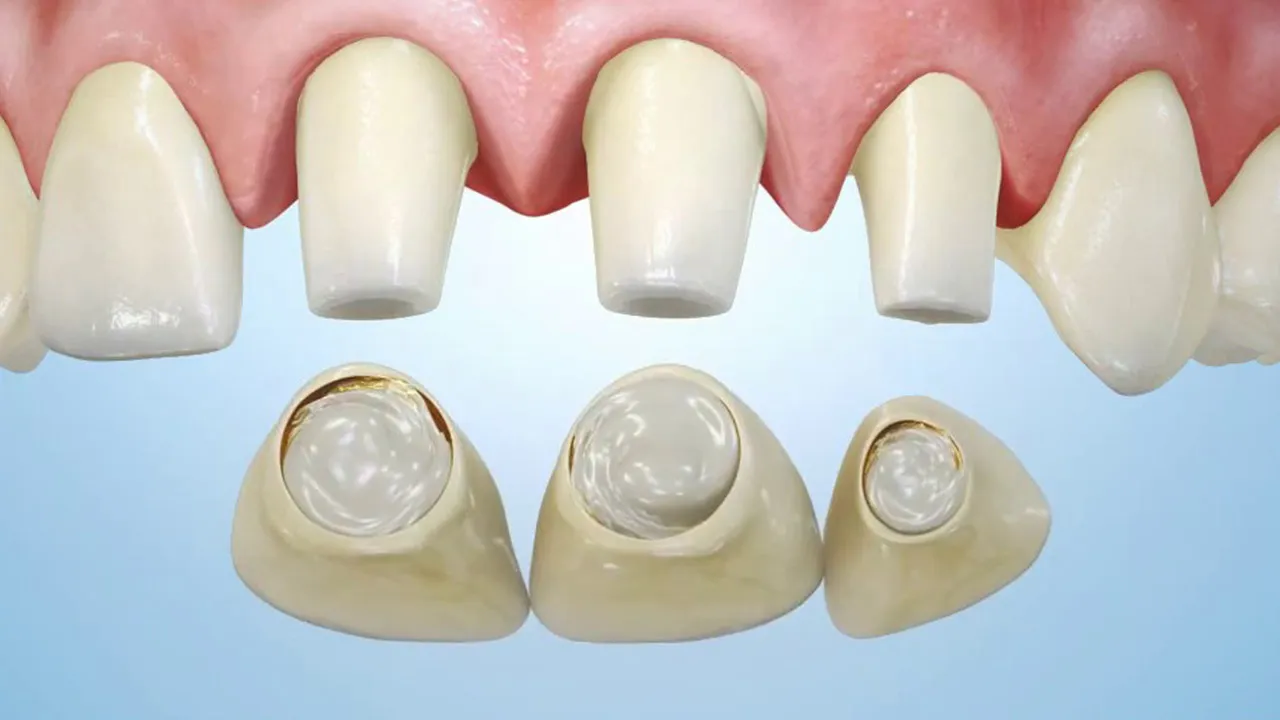 Dental Veneers Definition
