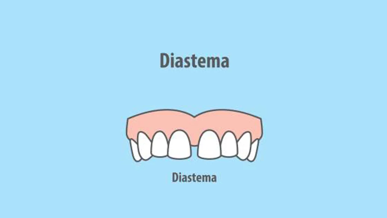 Diastema Definition